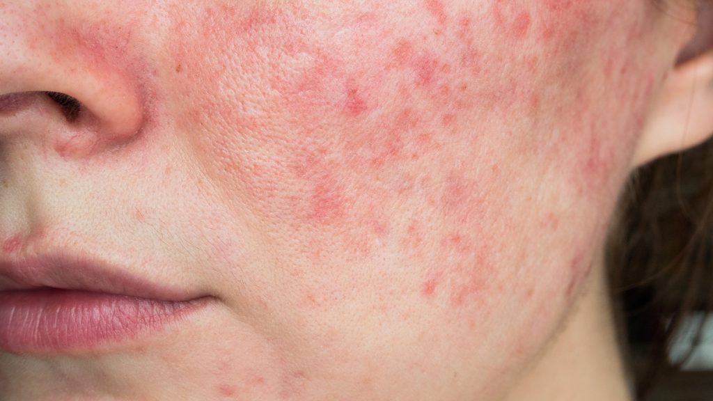 How to Prevent Rosacea