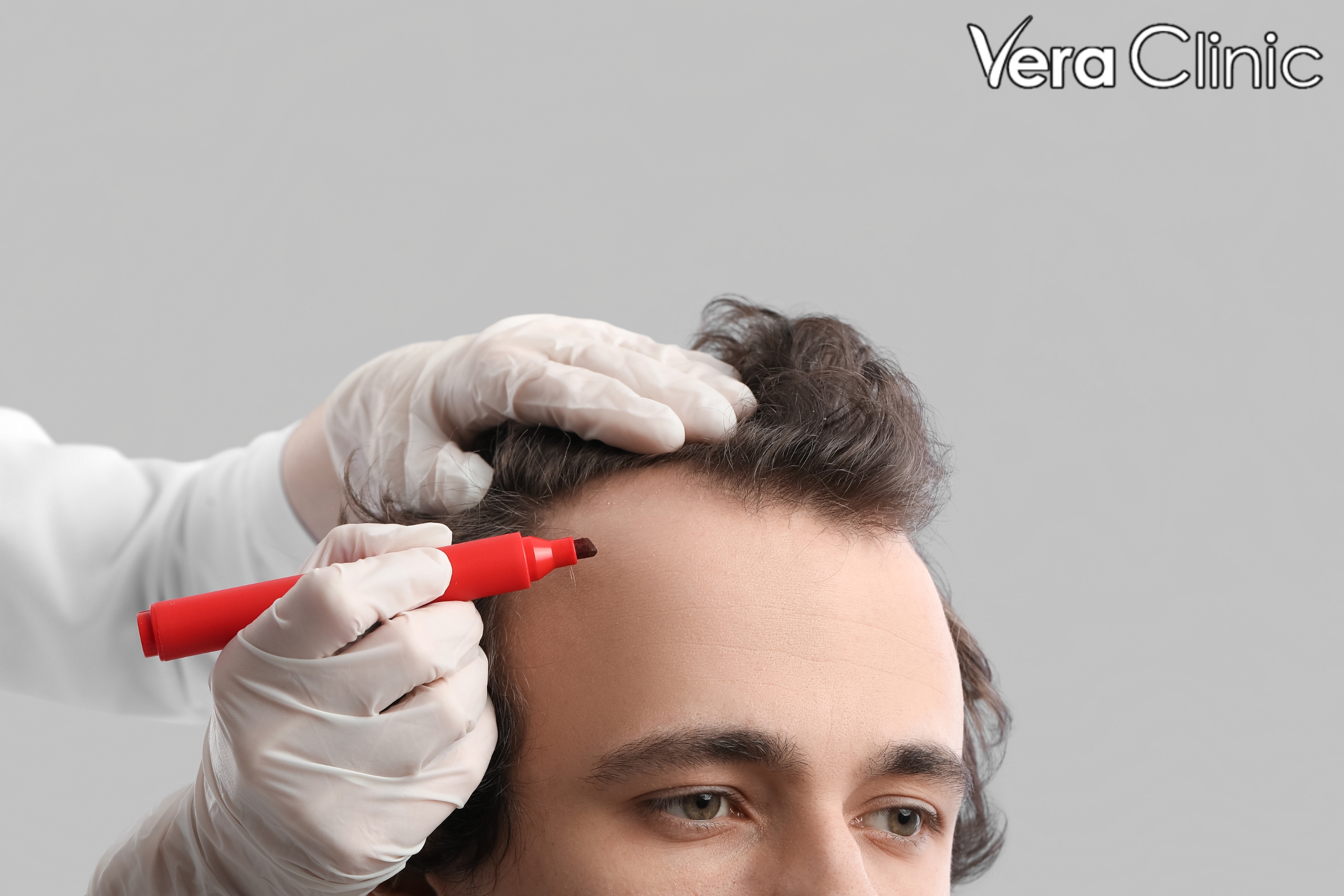 hair transplant istanbul