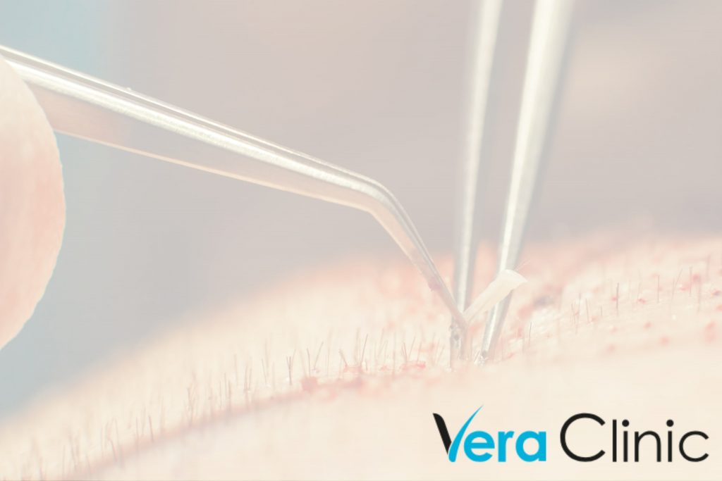Considering Hair Transplants In Istanbul? Here’s What You Need To Know